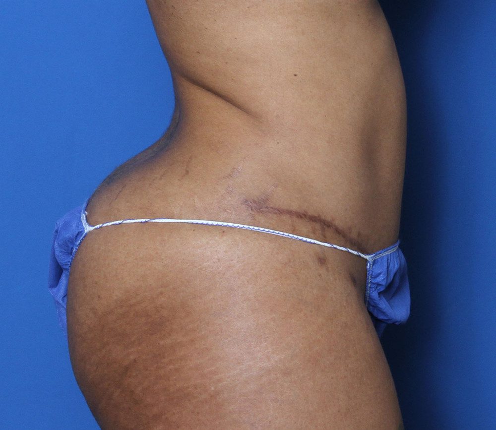 Tummy Tuck Patient Photo - Case 135 - after view-2