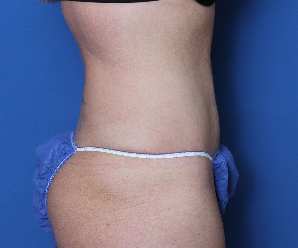 Tummy Tuck Patient Photo - Case 137 - after view-2