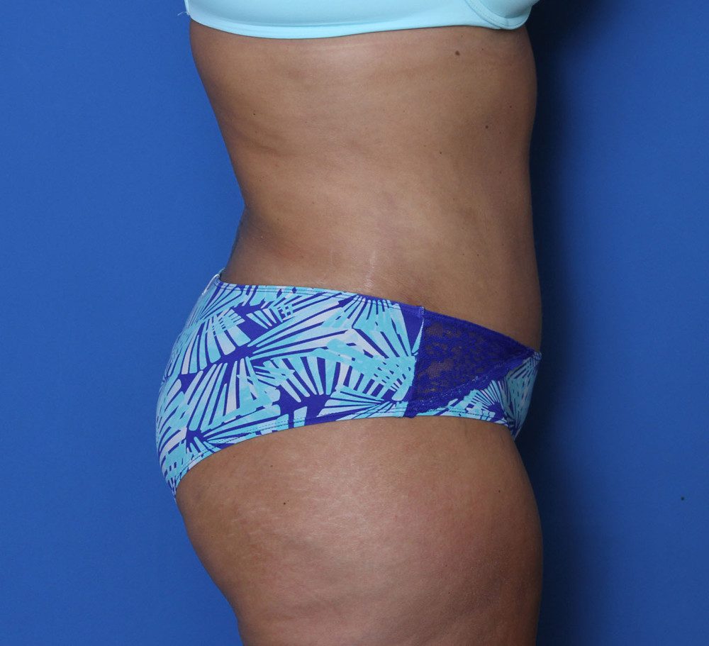 Tummy Tuck Patient Photo - Case 138 - after view-2