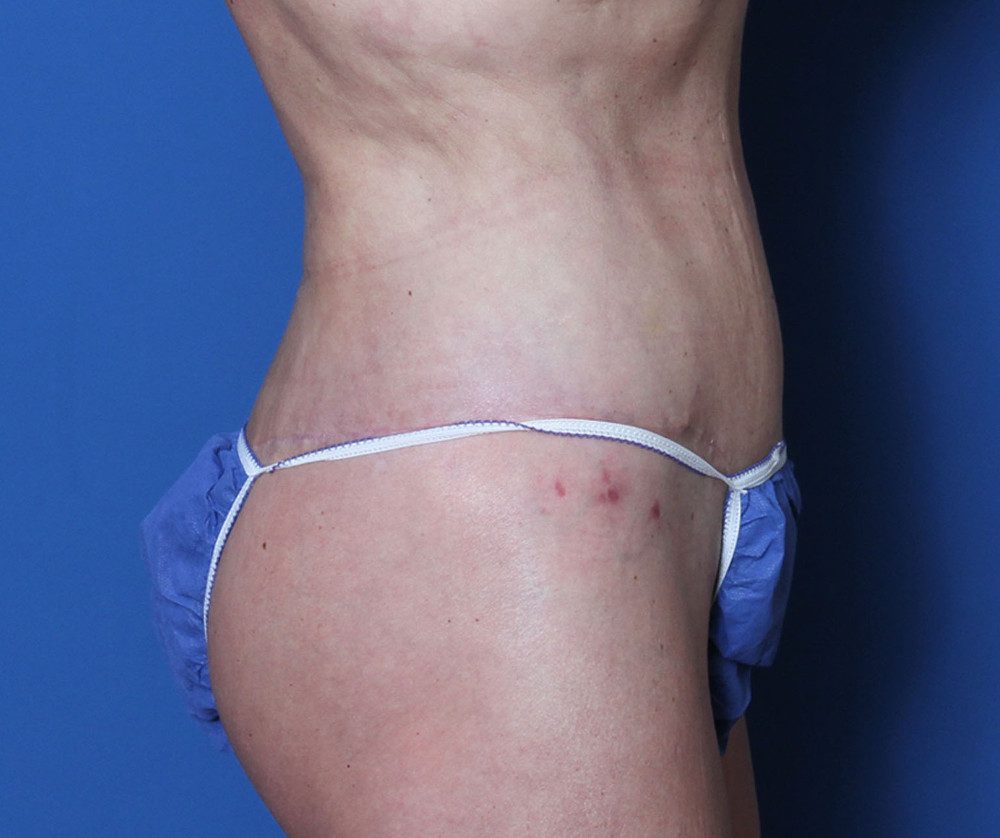Belt Lipectomy Patient Photo - Case 139 - after view-2