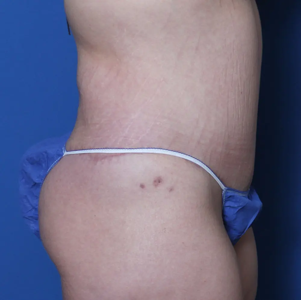 Belt Lipectomy Patient Photo - Case 140 - after view-2