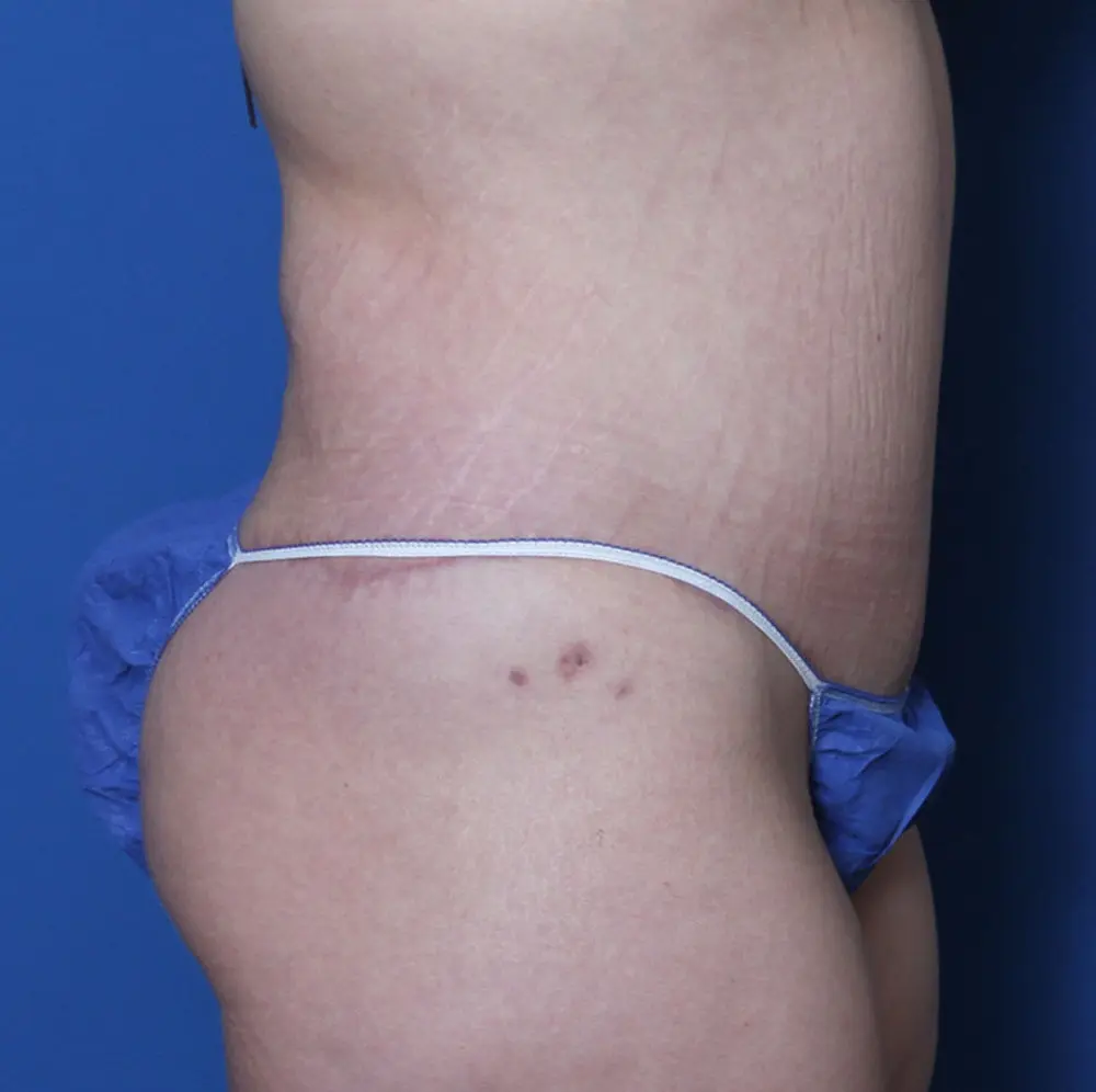 After Weight Loss Patient Photo - Case 140 - after view-2