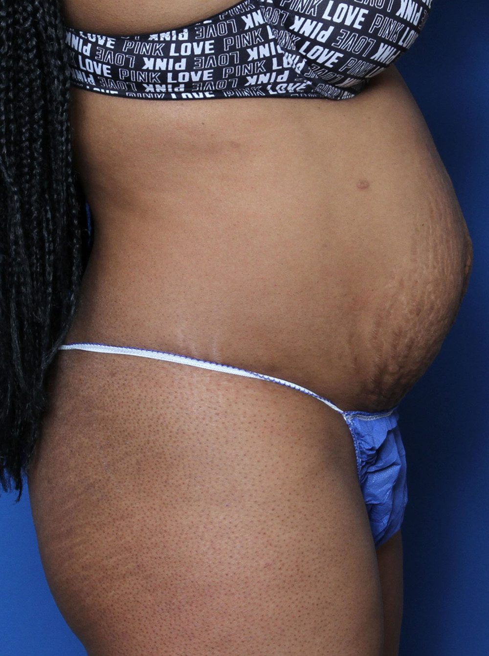 Tummy Tuck Patient Photo - Case 133 - before view-2