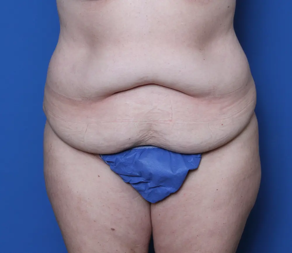 Belt Lipectomy Patient Photo - Case 145 - before view-0