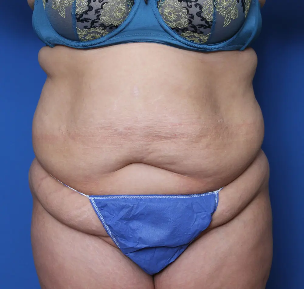 Belt Lipectomy - Case 146 - Before