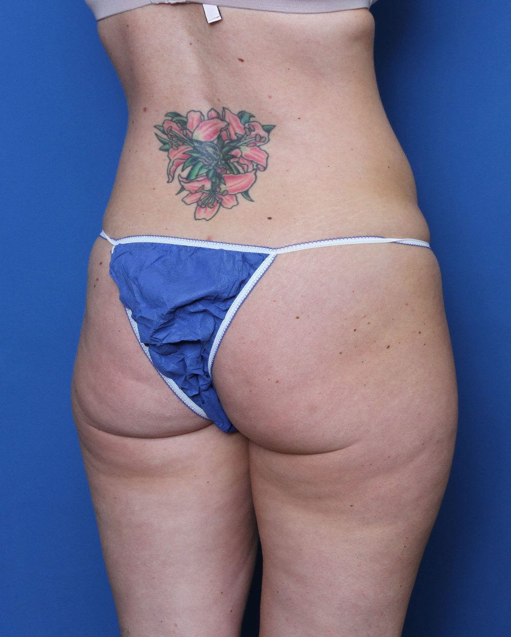 Liposuction Patient Photo - Case 156 - before view-2