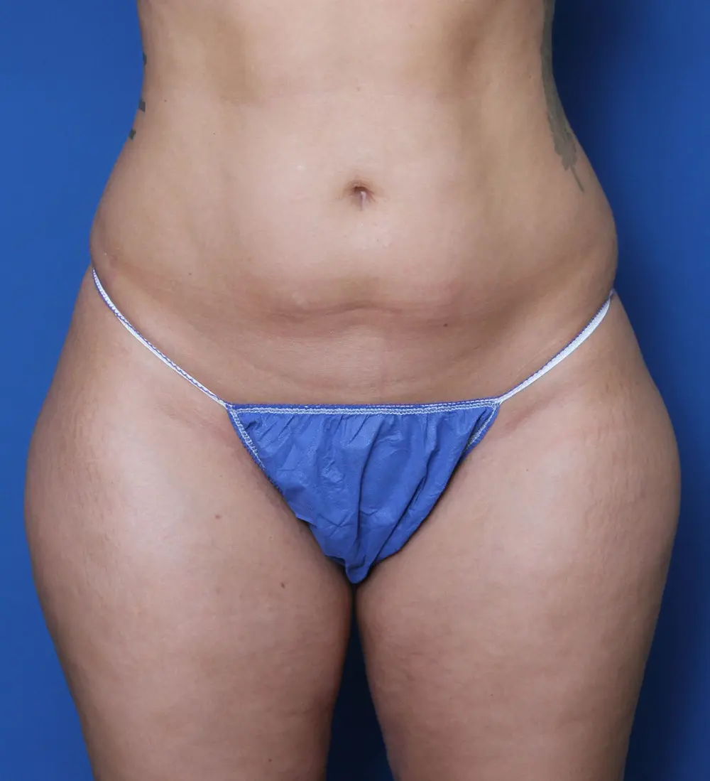 Liposuction Patient Photo - Case 158 - before view-0