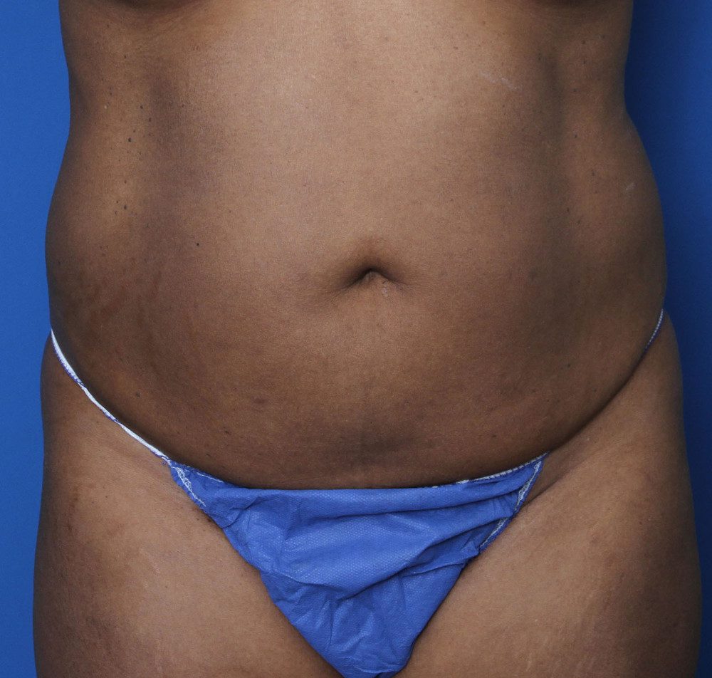 Tummy Tuck Patient Photo - Case 134 - before view-