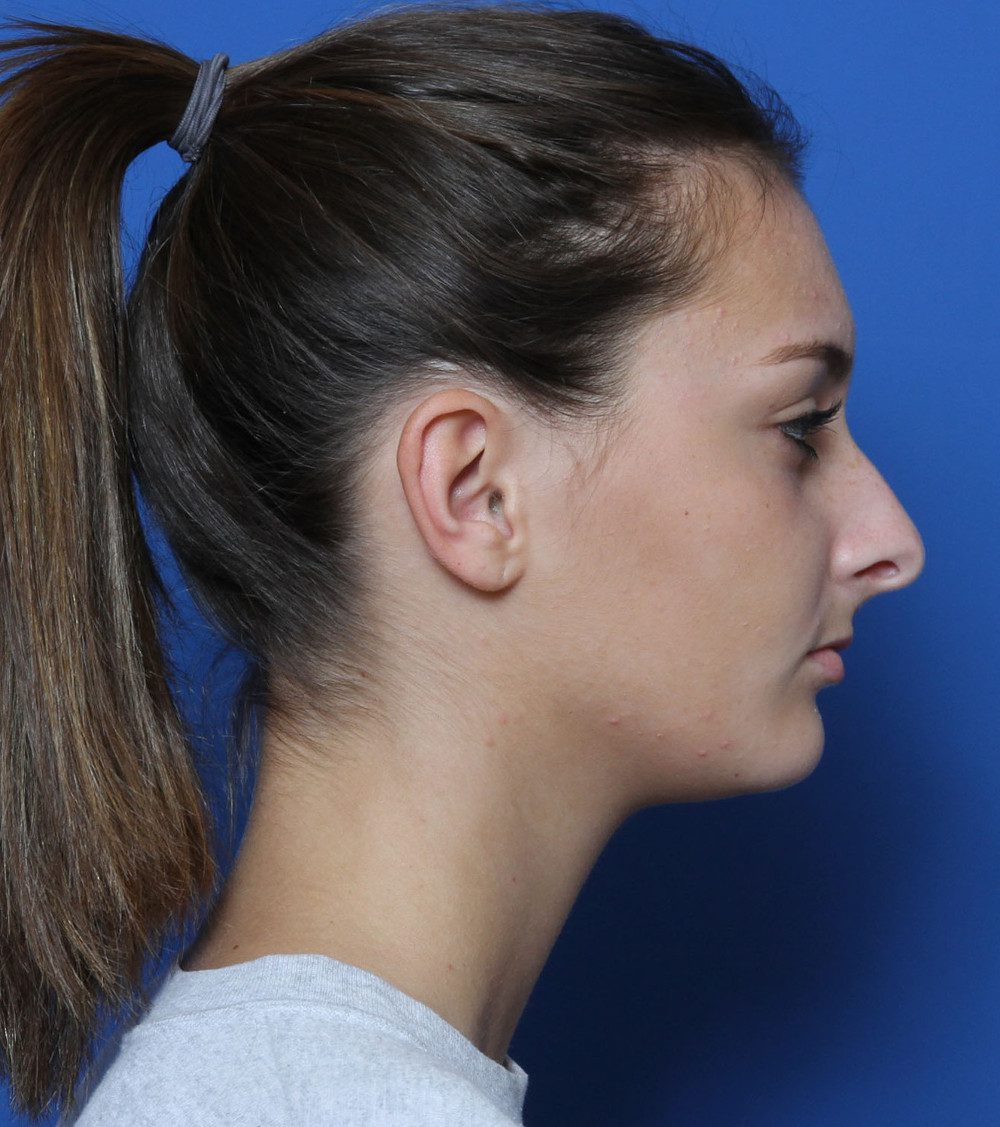 Rhinoplasty Patient Photo - Case 172 - before view-2
