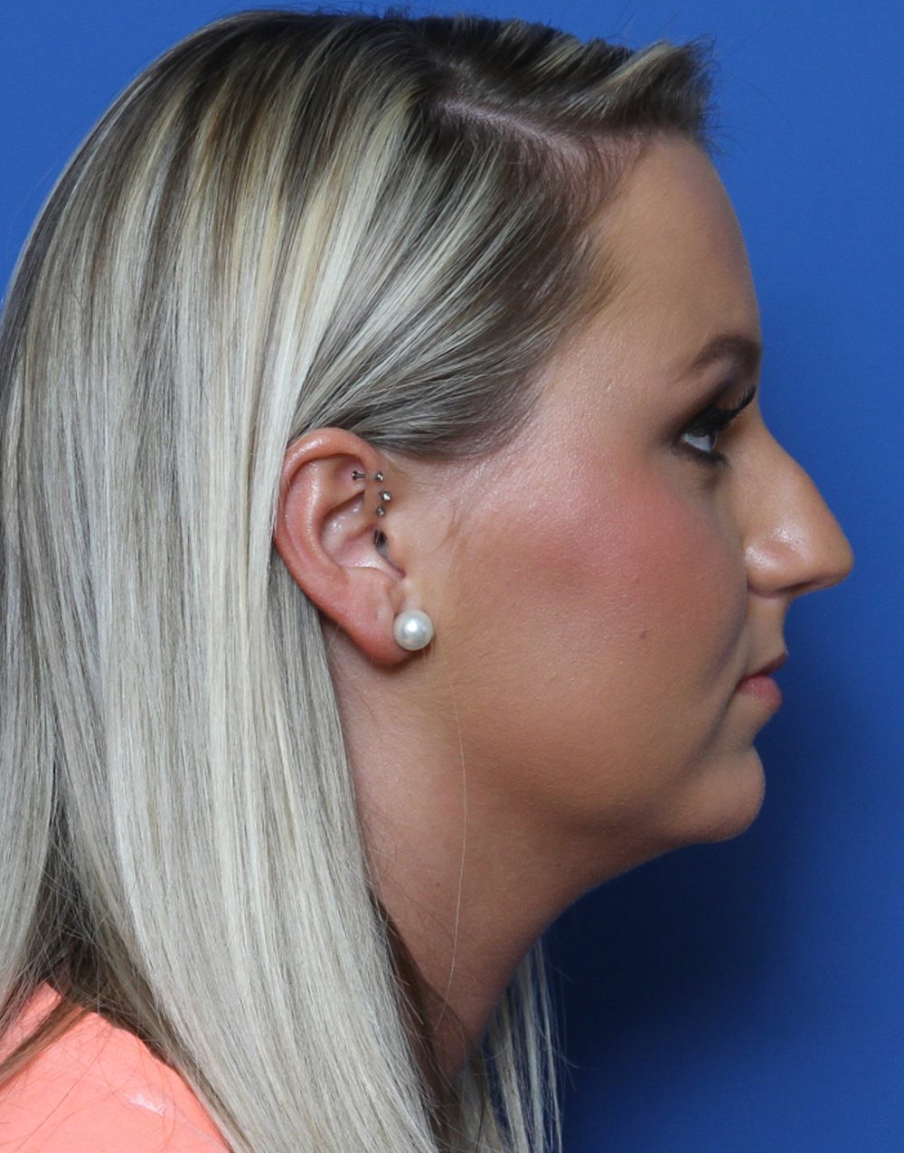 Rhinoplasty Patient Photo - Case 175 - before view-2