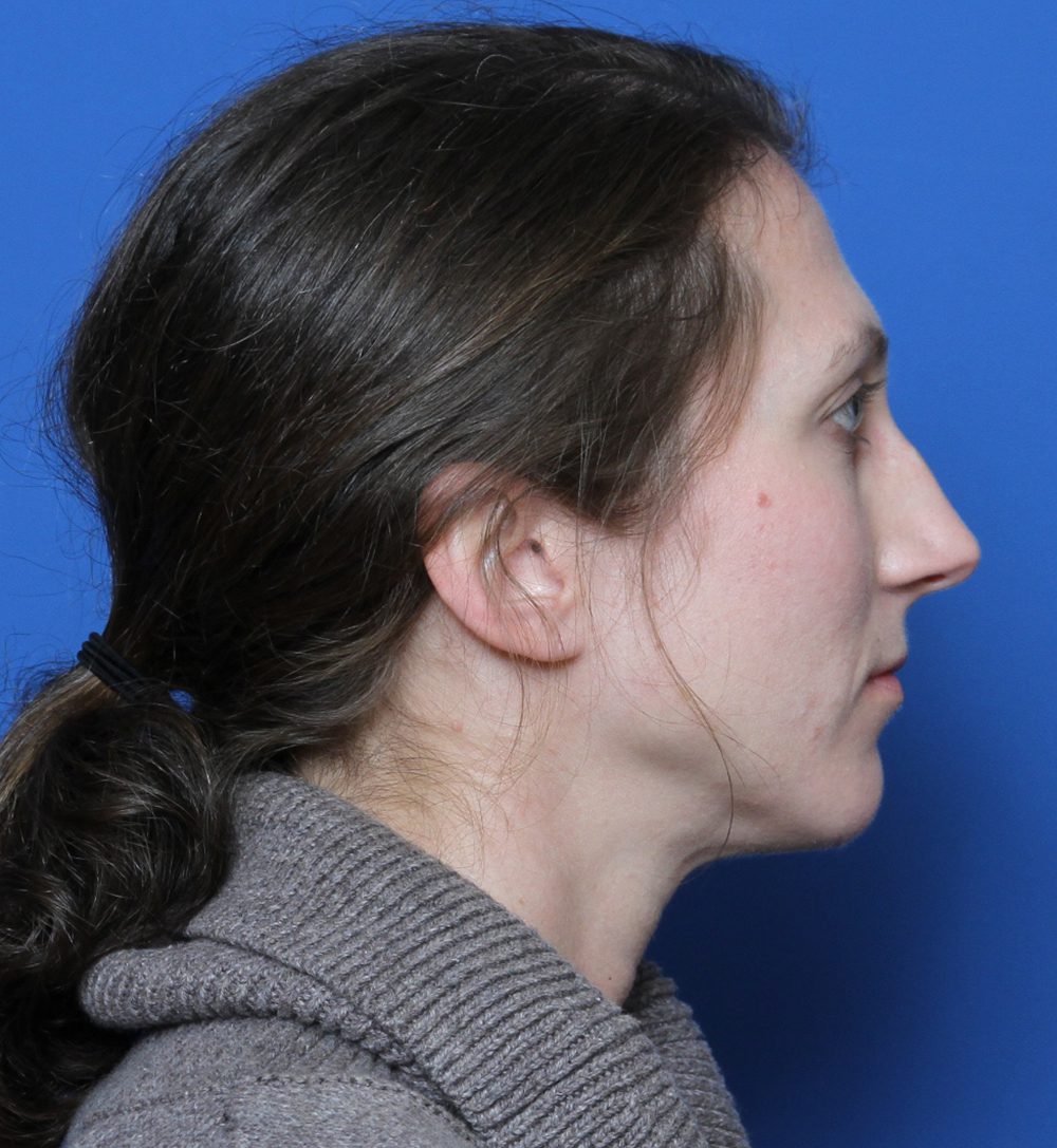 Rhinoplasty Patient Photo - Case 176 - before view-2