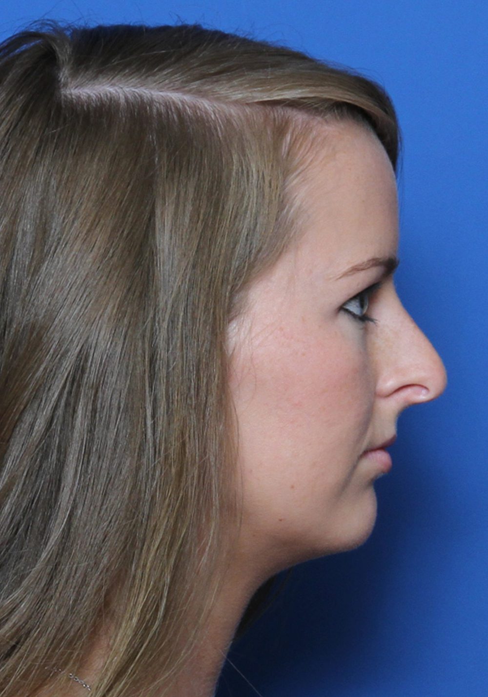 Rhinoplasty Patient Photo - Case 177 - before view-2