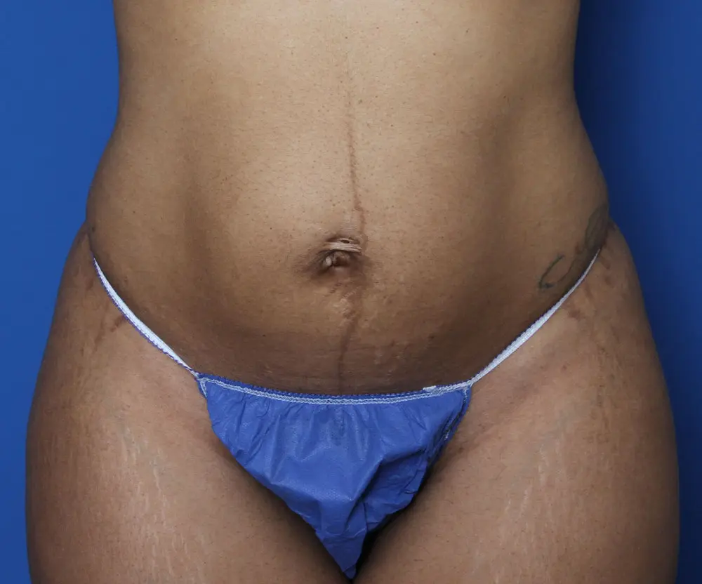 Tummy Tuck Patient Photo - Case 135 - before view-