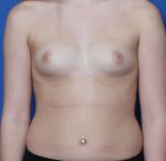 Breast Augmentation - Case 193 - Before