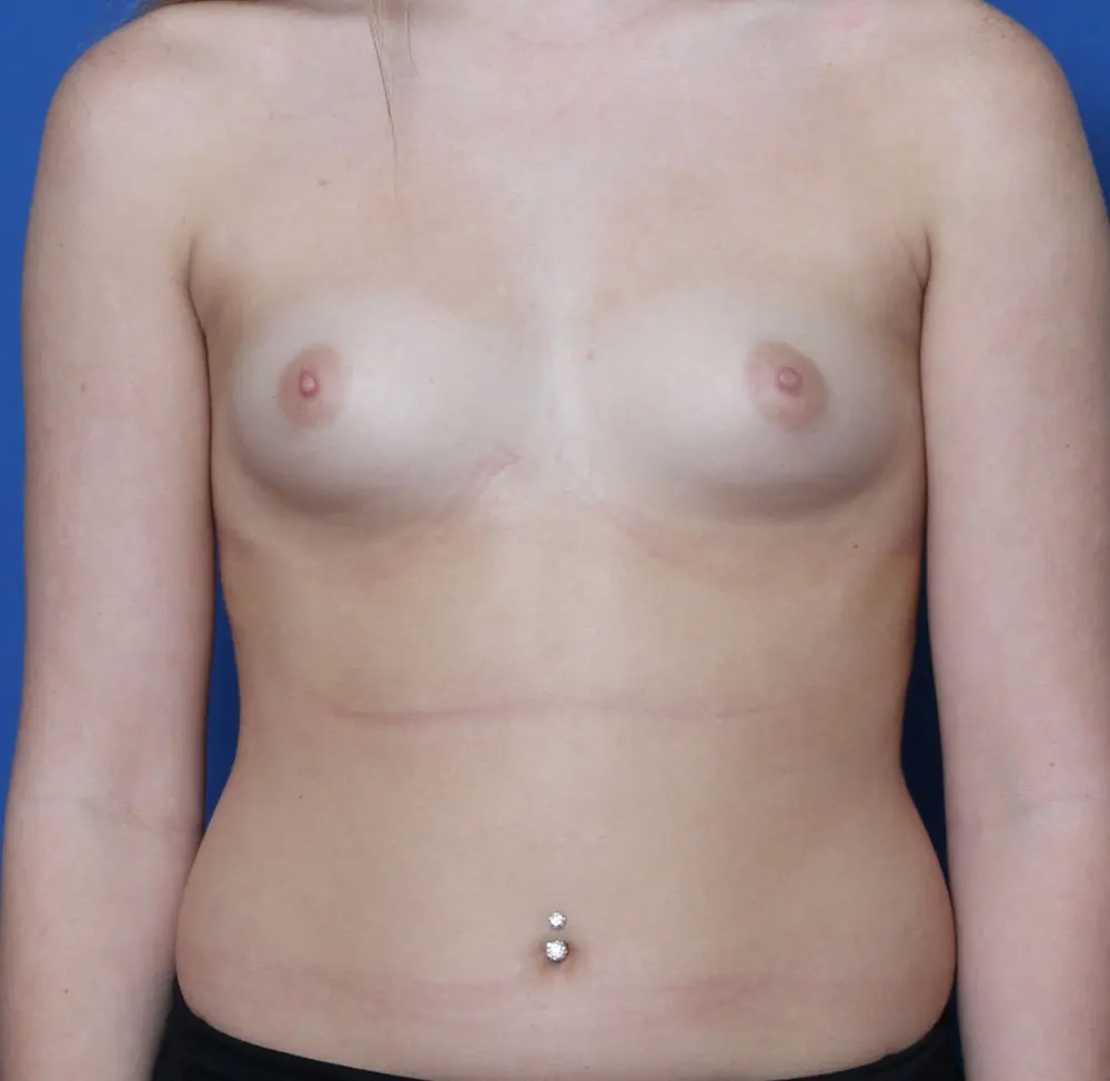 Breast Augmentation Patient Photo - Case 193 - before view-