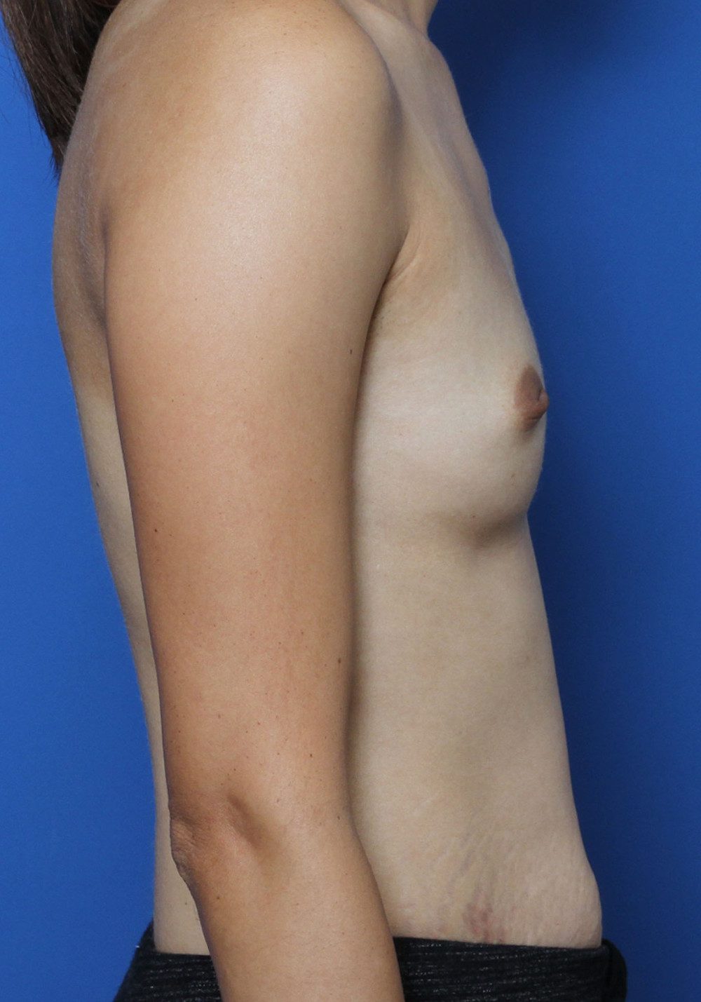Breast Augmentation Patient Photo - Case 194 - before view-2