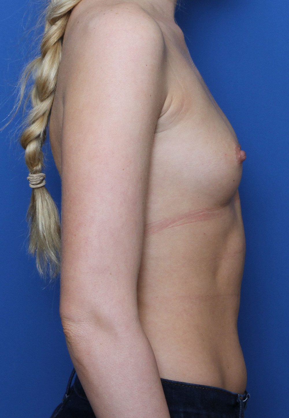 Breast Augmentation Patient Photo - Case 195 - before view-2