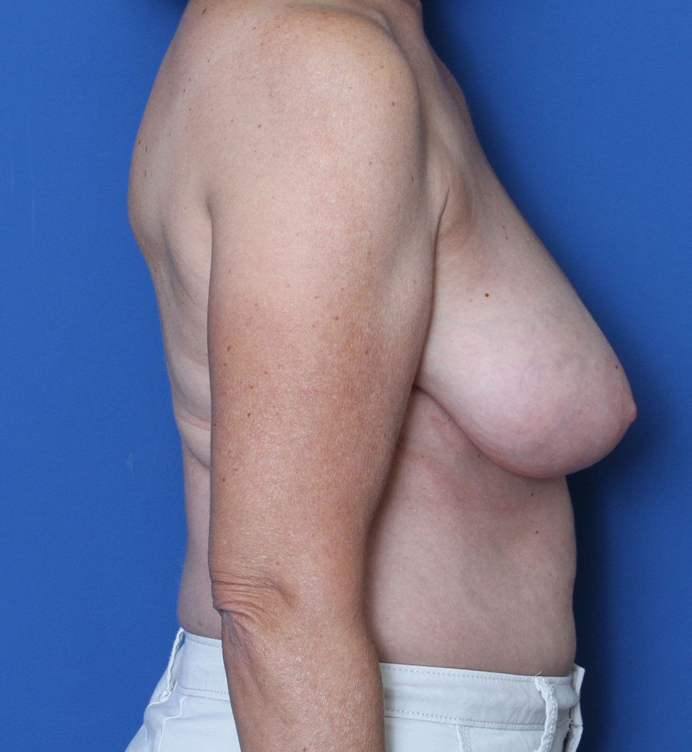 Breast Lift Patient Photo - Case 199 - before view-2