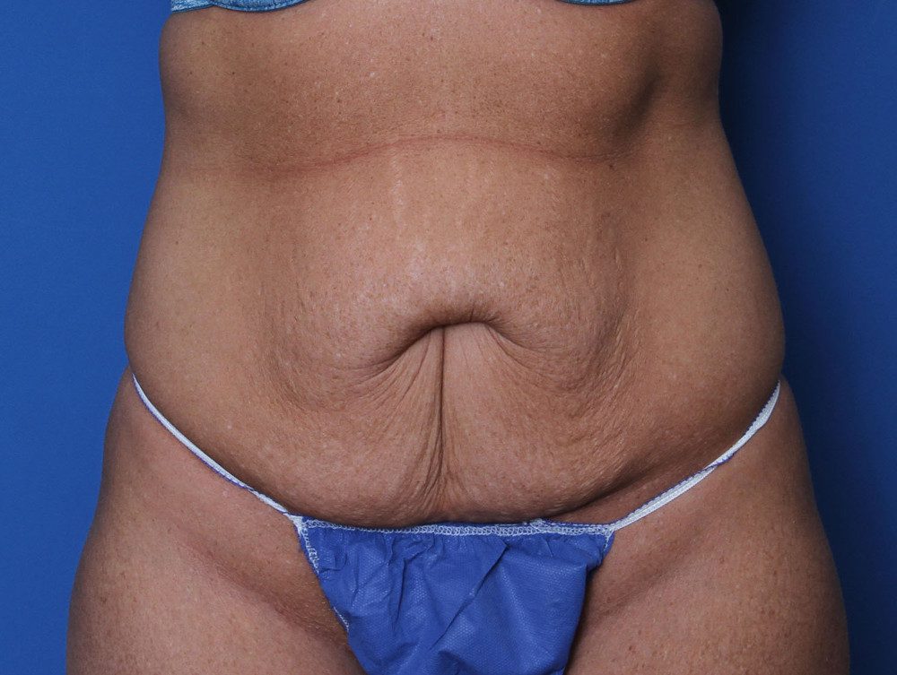 Tummy Tuck Patient Photo - Case 137 - before view-0