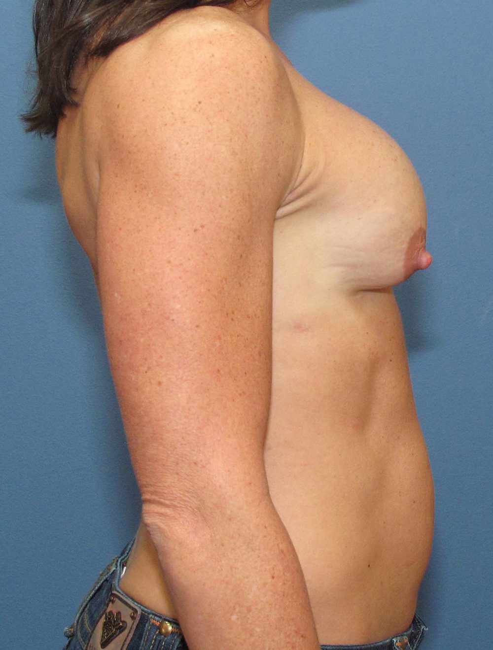 Breast Revision Patient Photo - Case 212 - before view-2