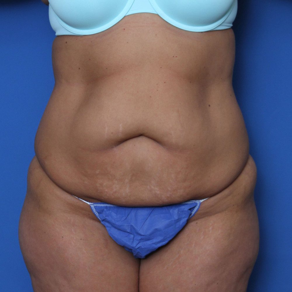 Tummy Tuck Patient Photo - Case 138 - before view-