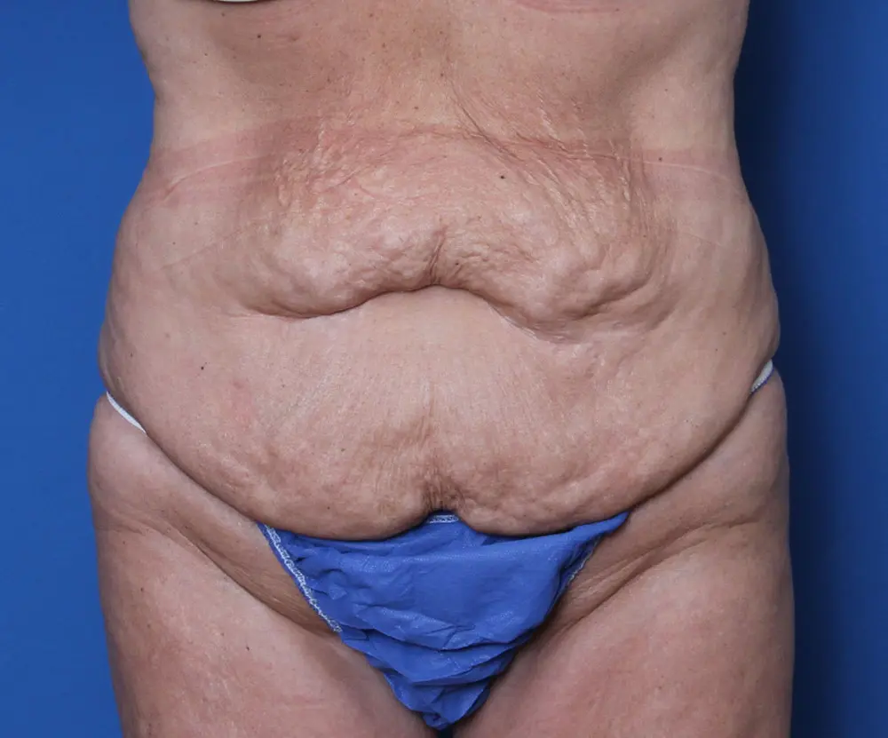 Belt Lipectomy Patient Photo - Case 139 - before view-0