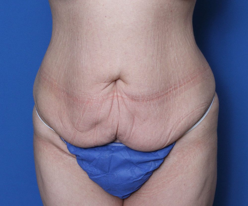 Belt Lipectomy Patient Photo - Case 140 - before view-