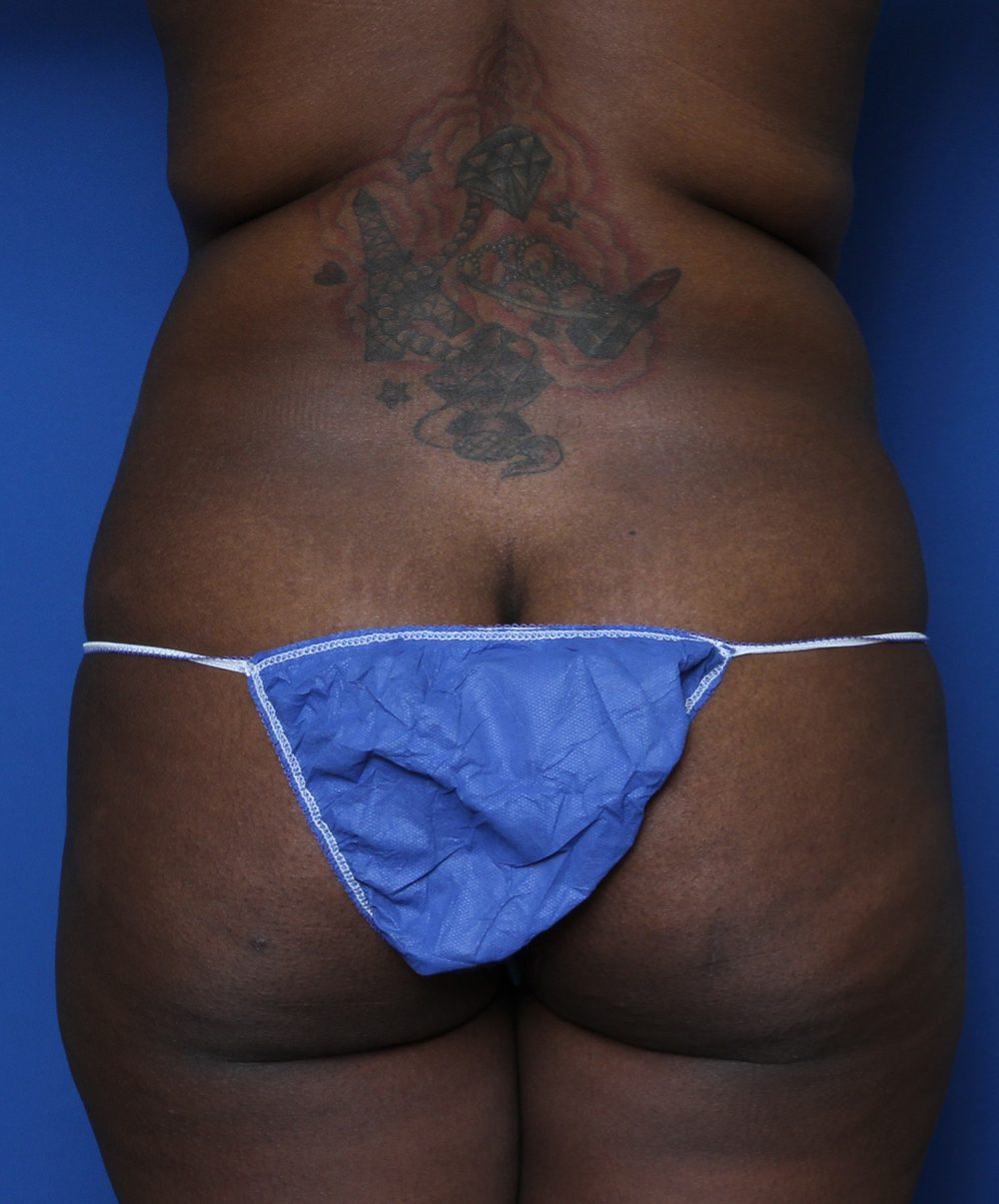 Tummy Tuck Patient Photo - Case 132 - before view-2