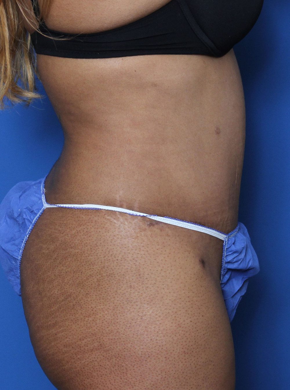 Tummy Tuck Patient Photo - Case 133 - after view-2