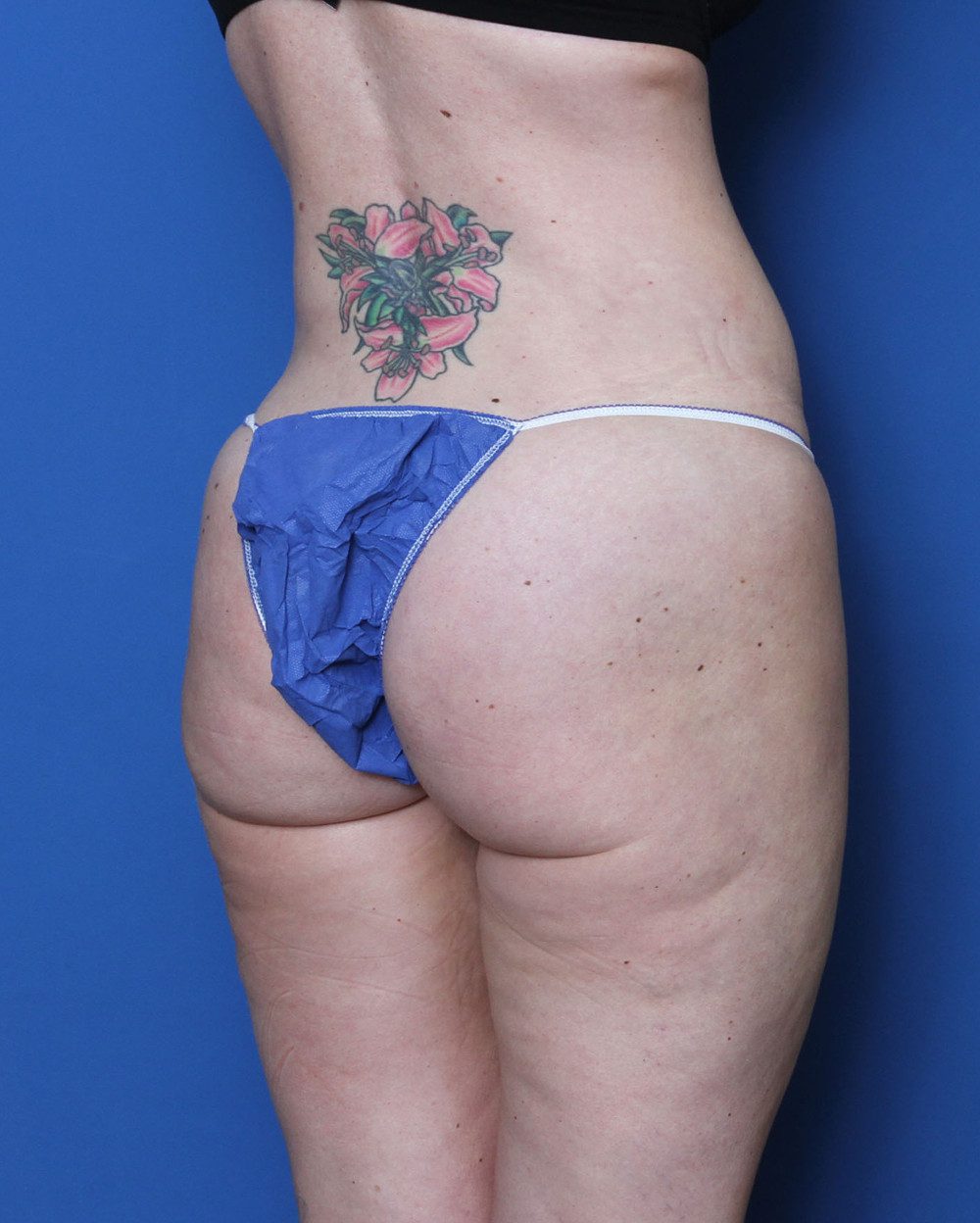 Liposuction Patient Photo - Case 156 - after view-2