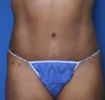 Tummy Tuck - Case 134 - After