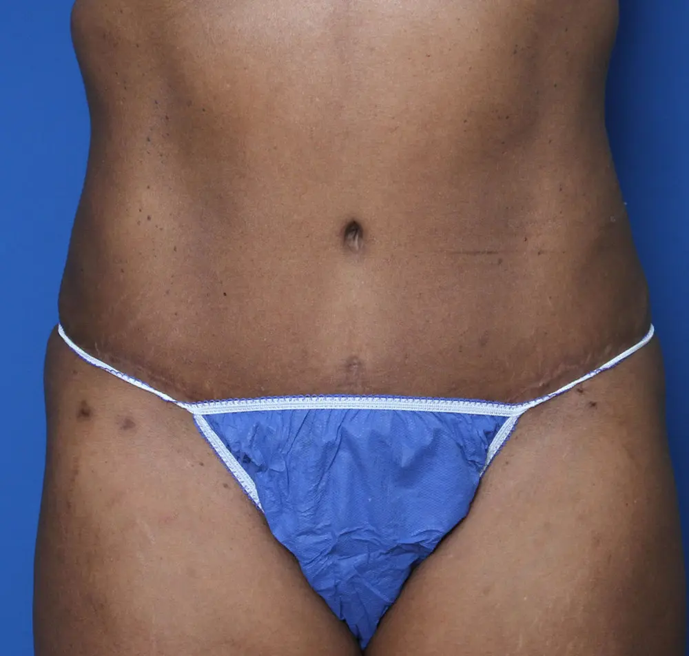 Tummy Tuck Patient Photo - Case 134 - after view