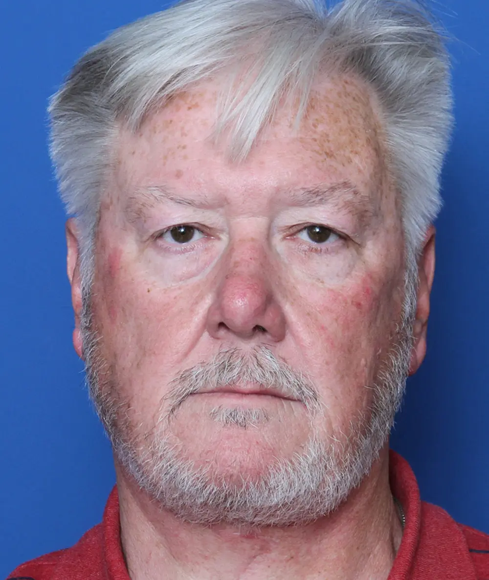 Neck Lift Patient Photo - Case 184 - after view