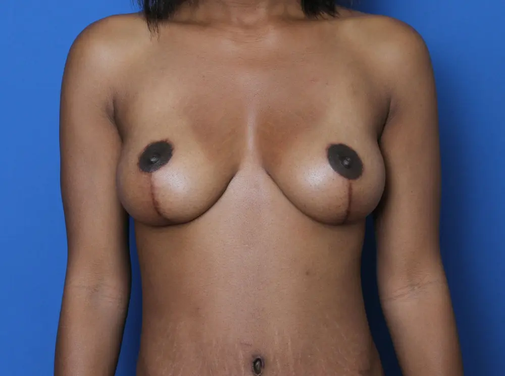 Breast Lift Patient Photo - Case 186 - after view-0