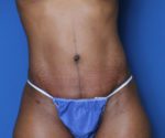 Tummy Tuck - Case 136 - After