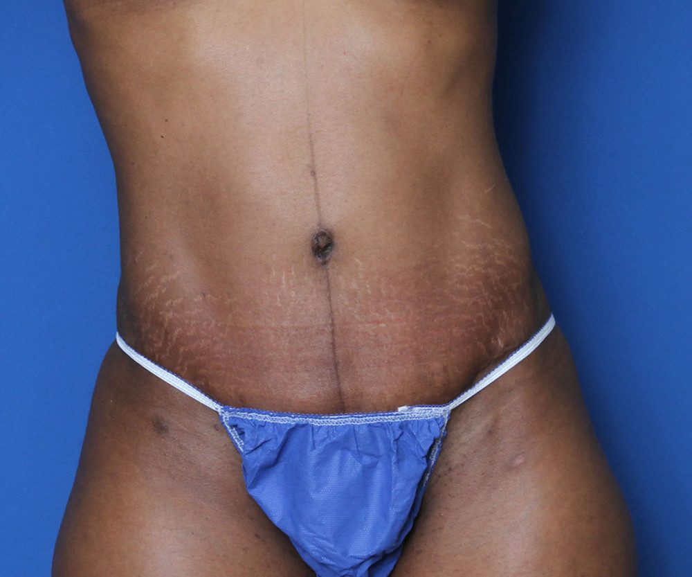 Tummy Tuck Patient Photo - Case 136 - after view