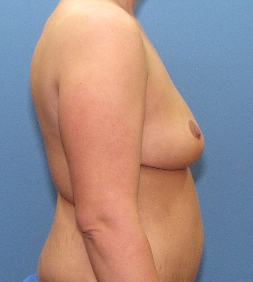Breast Lift Patient Photo - Case 198 - after view-2