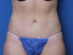 Tummy Tuck - Case 137 - After