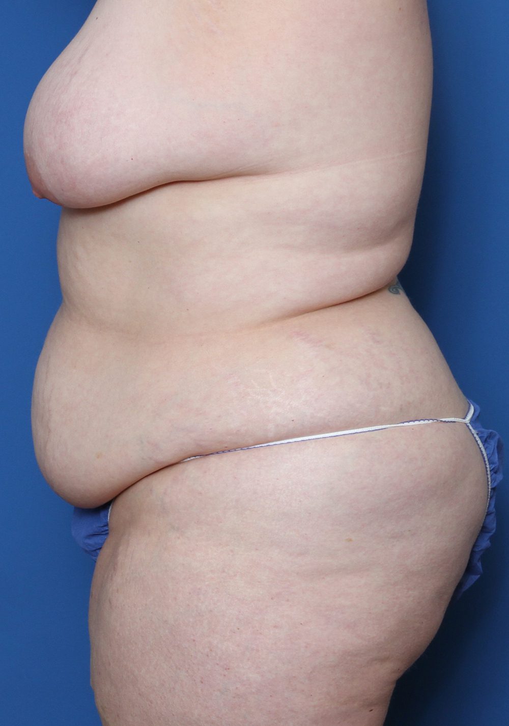 Belt Lipectomy Patient Photo - Case 143 - before view-3