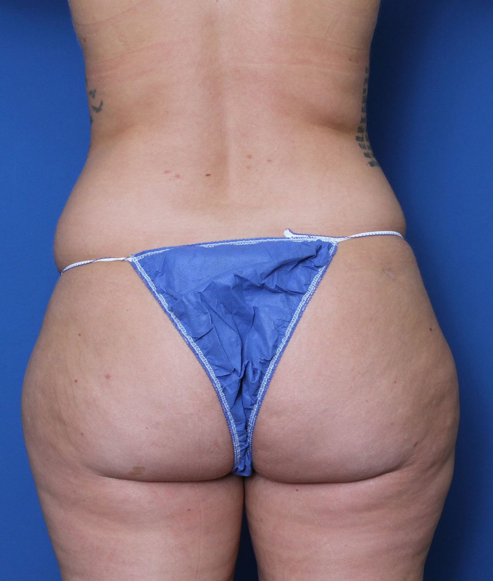 Liposuction Patient Photo - Case 158 - before view-3