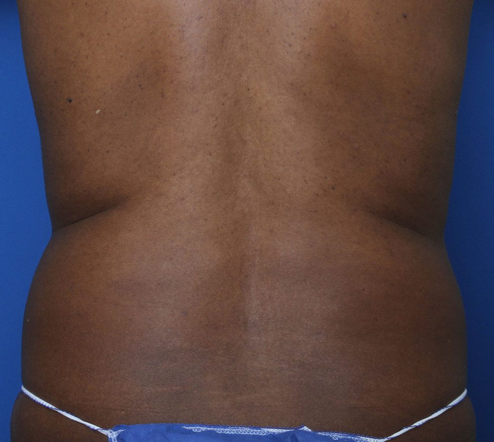 Tummy Tuck Patient Photo - Case 134 - before view-3
