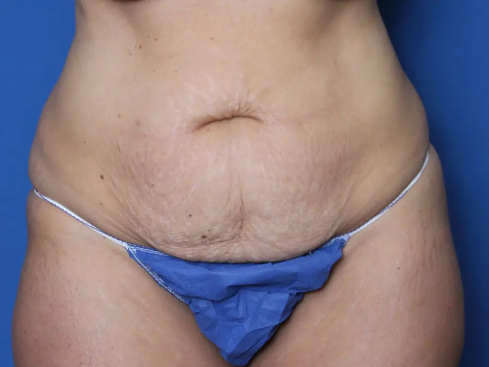 Tummy Tuck Patient Photo - Case 220 - before view-0