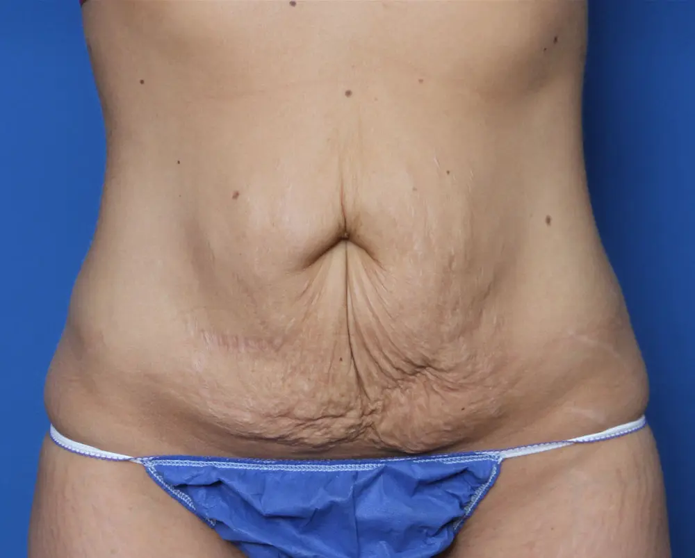 Tummy Tuck Patient Photo - Case 222 - before view-