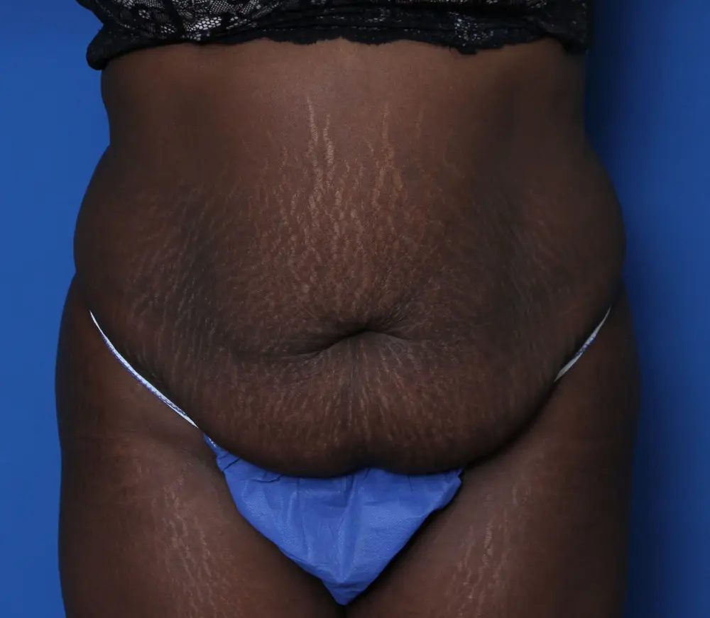 Tummy Tuck Patient Photo - Case 219 - before view-0