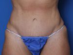Tummy Tuck - Case 220 - After