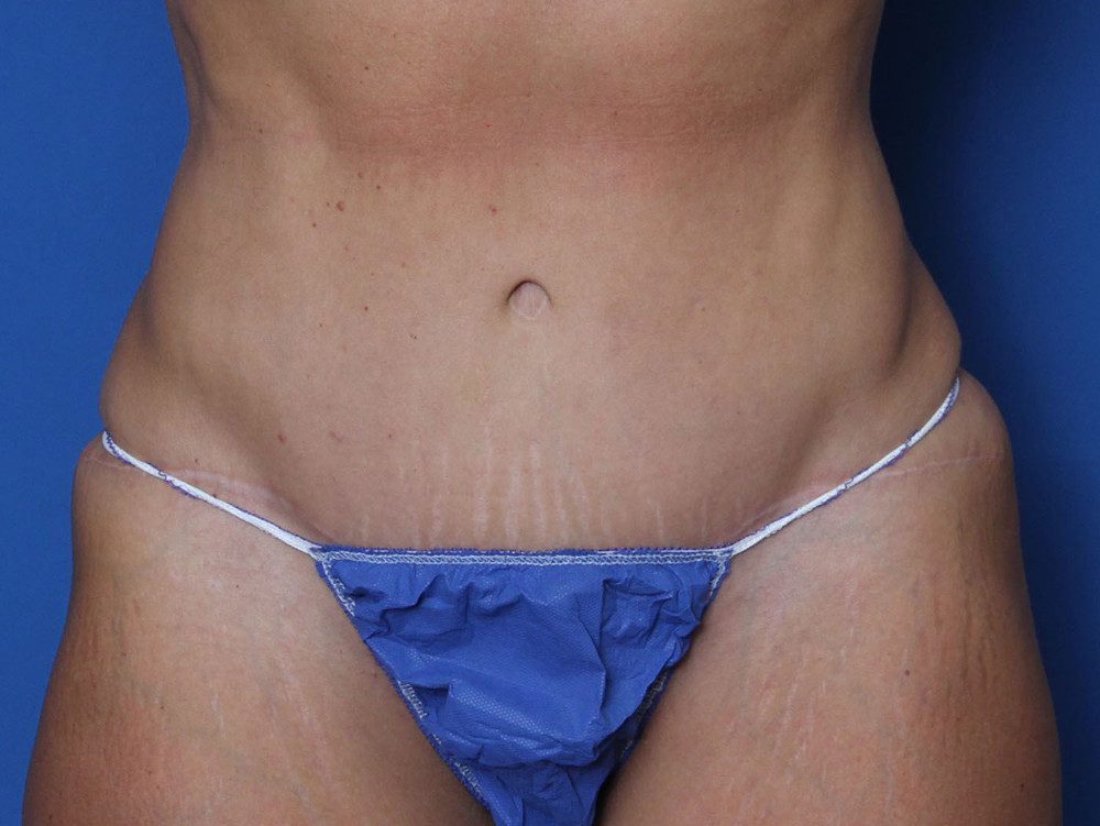 Tummy Tuck Patient Photo - Case 220 - after view