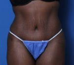 Tummy Tuck - Case 219 - After