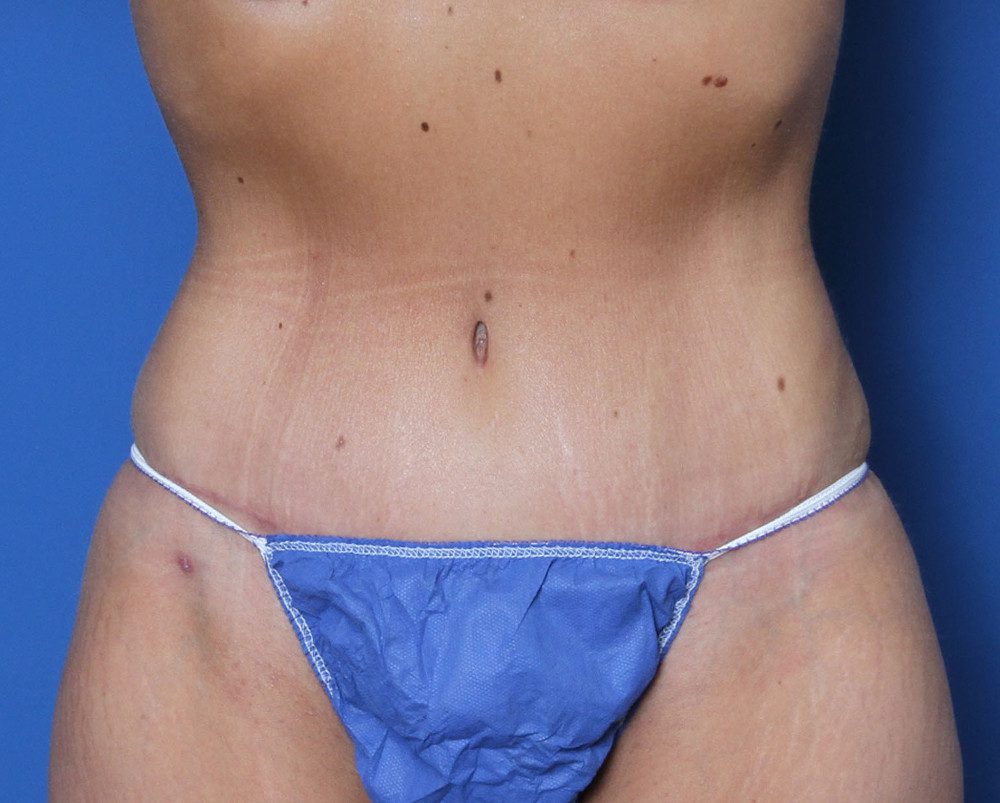 Tummy Tuck Patient Photo - Case 222 - after view-0