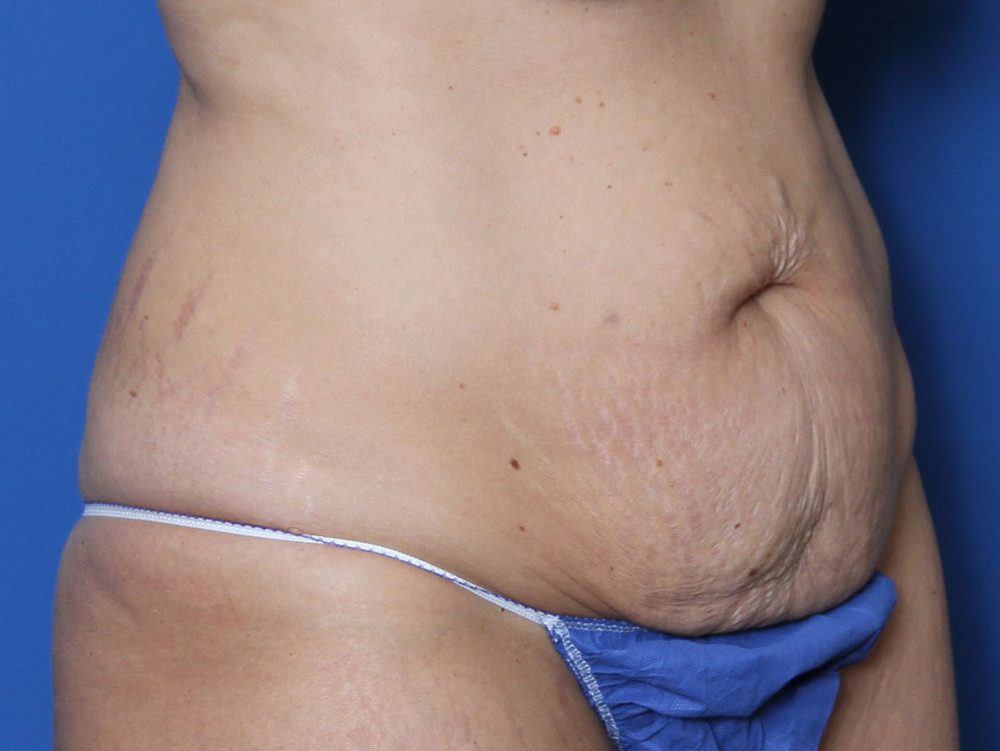 Tummy Tuck Patient Photo - Case 220 - before view-1