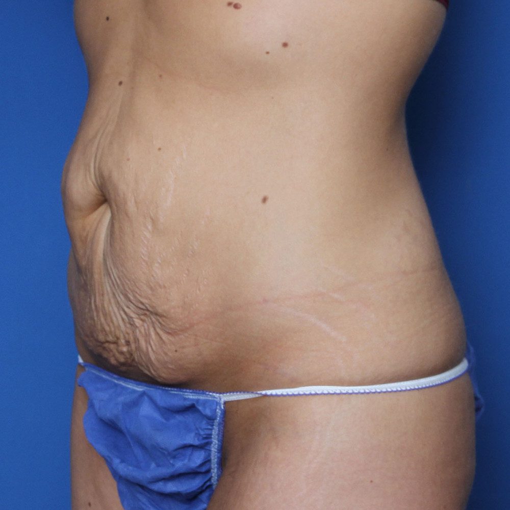 Tummy Tuck Patient Photo - Case 222 - before view-1